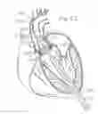 Fig. 09 - Retaining mechanisms for prosthetic heart valves