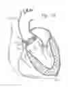 Fig. 10 - Retaining mechanisms for prosthetic heart valves