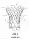 Fig. 02 - Cuff configurations for prosthetic heart valve