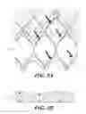 Fig. 09 - Cuff configurations for prosthetic heart valve