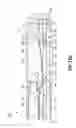 Fig. 20 - Device for expanding and supporting body tissue