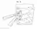 Fig. 40 - Intervertebral disc and insertion methods therefor