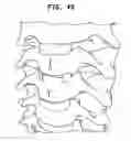 Fig. 43 - Intervertebral disc and insertion methods therefor