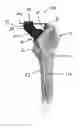 Fig. 01 - Trial instrument assembly for use in a surgical procedure