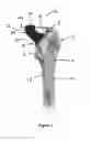 Fig. 02 - Trial instrument assembly for use in a surgical procedure