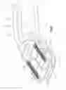 Fig. 14 - Dynamic trial implants