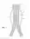 Fig. 02 - Bifurcated graft device