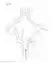 Fig. 12 - Protuberant aneurysm bridging device deployment method
