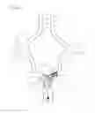 Fig. 14 - Protuberant aneurysm bridging device deployment method