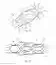 Fig. 16 - Protuberant aneurysm bridging device deployment method