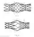 Fig. 20 - Protuberant aneurysm bridging device deployment method