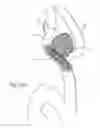 Fig. 28 - Protuberant aneurysm bridging device deployment method