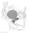 Fig. 32 - Protuberant aneurysm bridging device deployment method