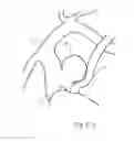 Fig. 33 - Protuberant aneurysm bridging device deployment method