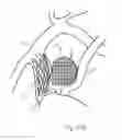 Fig. 34 - Protuberant aneurysm bridging device deployment method