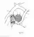 Fig. 35 - Protuberant aneurysm bridging device deployment method