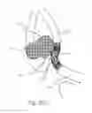 Fig. 38 - Protuberant aneurysm bridging device deployment method