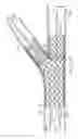 Fig. 24 - Deployment of Stents within Bifurcated Vessels
