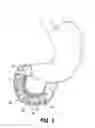 Fig. 02 - Duodenum sleeve for treating obesity