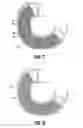 Fig. 05 - Duodenum sleeve for treating obesity