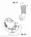 Fig. 04 - Orthopedic Cast