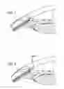 Fig. 02 - Intracameral sustained release therapeutic agent implants
