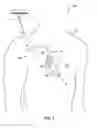 Fig. 02 - Determination of hemodynamic intolerance of ventricular pacing