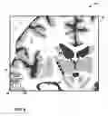 Fig. 07 - User interface with 3D environment for configuring stimulation therapy