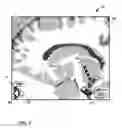 Fig. 08 - User interface with 3D environment for configuring stimulation therapy