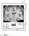 Fig. 34 - User interface with 3D environment for configuring stimulation therapy