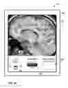 Fig. 35 - User interface with 3D environment for configuring stimulation therapy