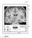 Fig. 37 - User interface with 3D environment for configuring stimulation therapy