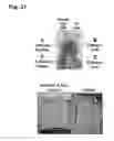 Fig. 34 - Peptides that stimulate subcutaneous adipogenesis