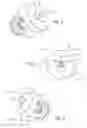 Fig. 05 - Vibration Damping Device