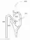 Fig. 01 - Paranasal sinus access system