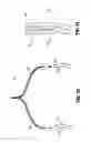 Fig. 30 - Specimen retrieval device with pouch stop