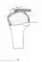Fig. 02 - Arthroscopic Method and Apparatus for Rotator Cuff Repair