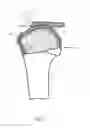 Fig. 03 - Arthroscopic Method and Apparatus for Rotator Cuff Repair