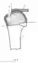 Fig. 04 - Arthroscopic Method and Apparatus for Rotator Cuff Repair
