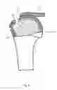 Fig. 06 - Arthroscopic Method and Apparatus for Rotator Cuff Repair