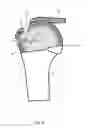 Fig. 07 - Arthroscopic Method and Apparatus for Rotator Cuff Repair