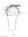 Fig. 09 - Arthroscopic Method and Apparatus for Rotator Cuff Repair