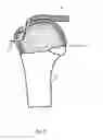 Fig. 10 - Arthroscopic Method and Apparatus for Rotator Cuff Repair