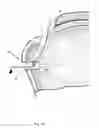 Fig. 14 - Arthroscopic Method and Apparatus for Rotator Cuff Repair