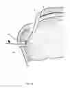 Fig. 15 - Arthroscopic Method and Apparatus for Rotator Cuff Repair