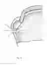 Fig. 16 - Arthroscopic Method and Apparatus for Rotator Cuff Repair