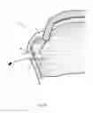Fig. 20 - Arthroscopic Method and Apparatus for Rotator Cuff Repair