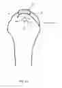 Fig. 22 - Arthroscopic Method and Apparatus for Rotator Cuff Repair