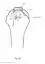 Fig. 23 - Arthroscopic Method and Apparatus for Rotator Cuff Repair