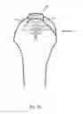 Fig. 24 - Arthroscopic Method and Apparatus for Rotator Cuff Repair